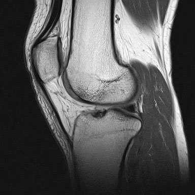 X-ray image of my broken knee